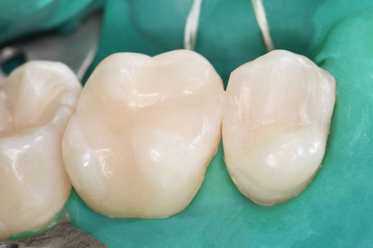 Zubni plak može biti povezan s nakupljanjem plaka u arterijama i većim kardiovaskularnim rizikom detail 1