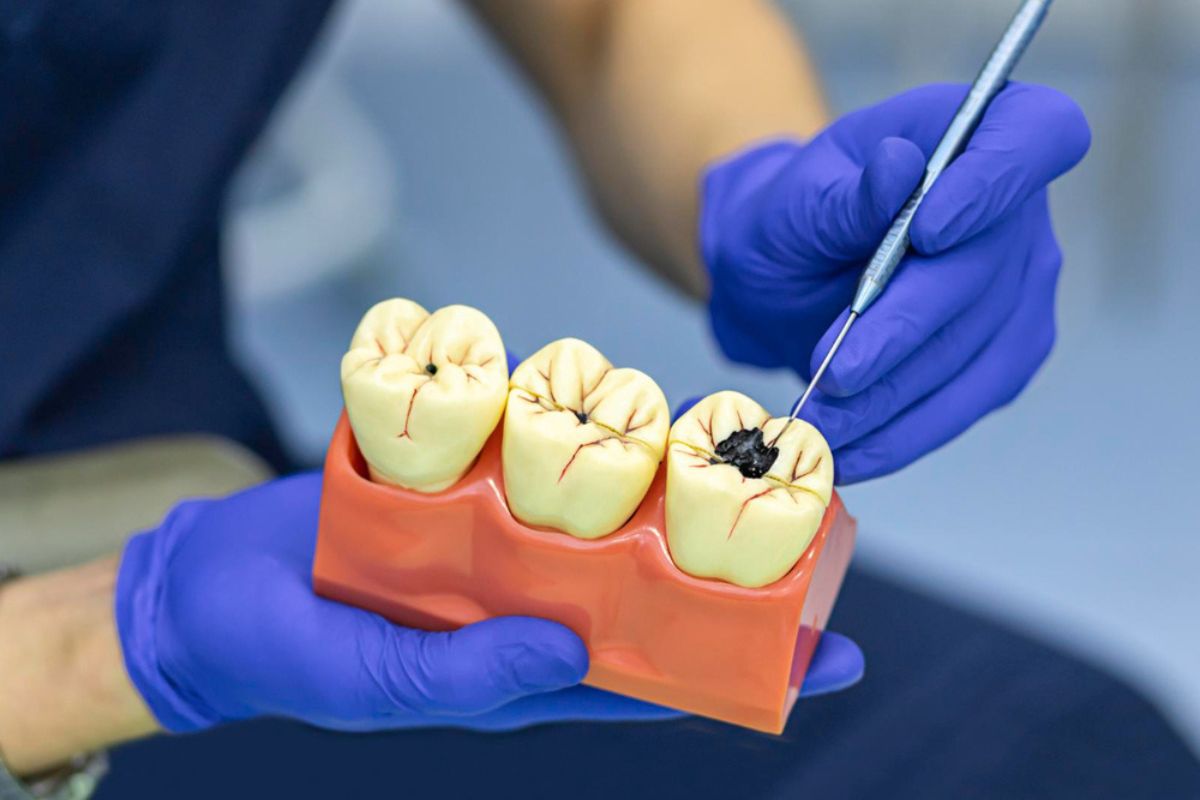 Zubni plak može biti povezan s nakupljanjem plaka u arterijama i većim kardiovaskularnim rizikom detail 3