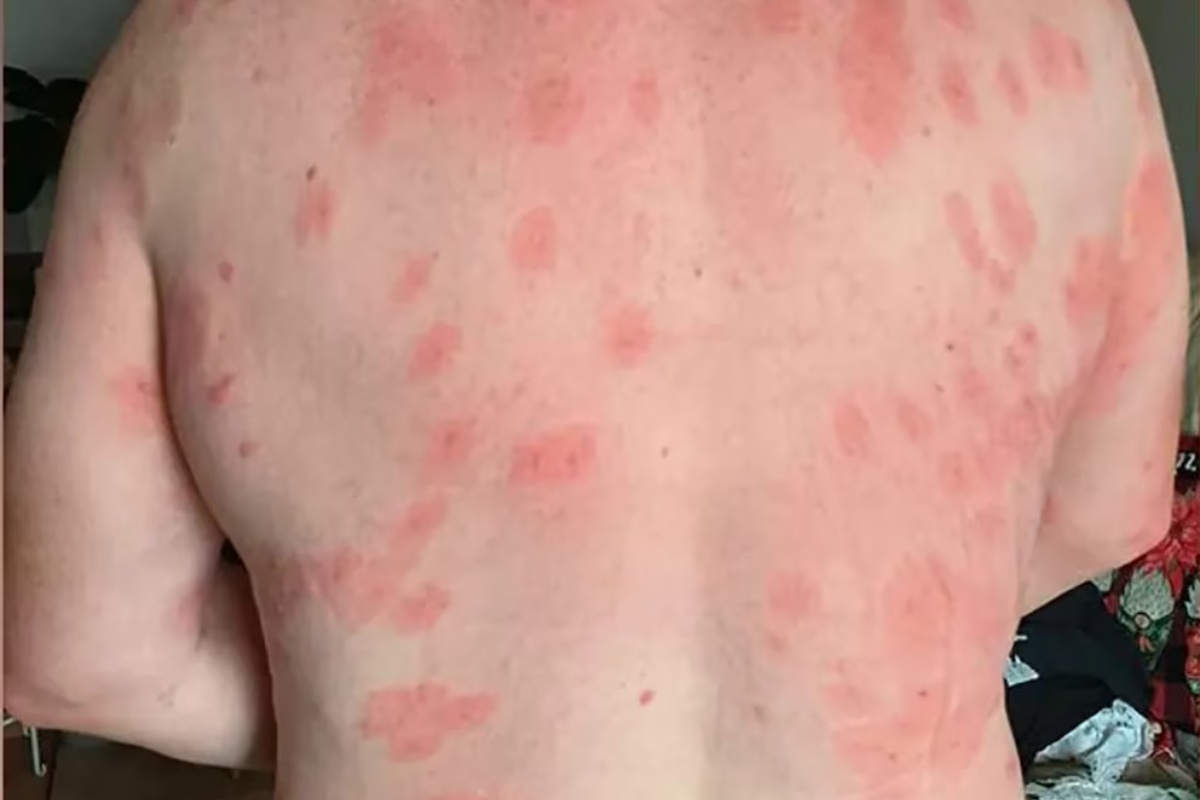 Što učiniti u slučaju uboda ose i kada on postaje hitan medicinski slučaj detail 4